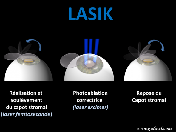 Lasik etapes 590x442